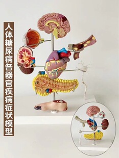 Human diabetes organ symptom model demonstration detachable teaching control foot disease pancreas eyeball heart diagram