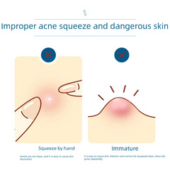 廠家不鏽鋼粉刺針5件套 痘痘夾細胞夾去黑頭鑷清潔臉部痕美容工具
