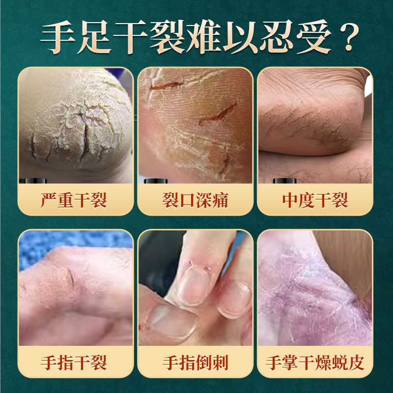 马油皲裂膏手足冻疮干裂膏滋润皮肤修护手霜脚裂足跟裂膏马油膏|undefined