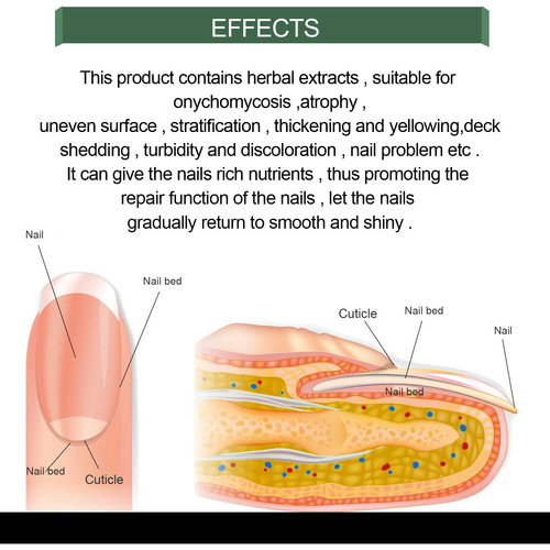 eelhoe Onychomycosis Repair Solution Thickening Bright Nail Soft Nail Solution Foot Care Solution Onychomycosis Manicure Care Solution