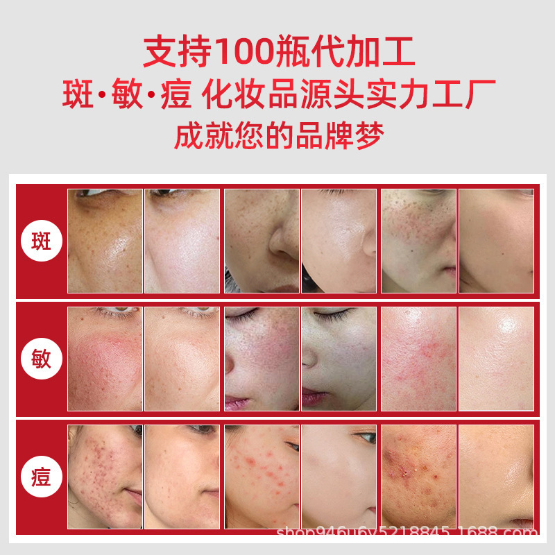【工場直販強化ニキビ水】サリチル酸フルーツ酸がニキビを除去し、ニキビ跡を薄くするエステサロン特選品|undefined