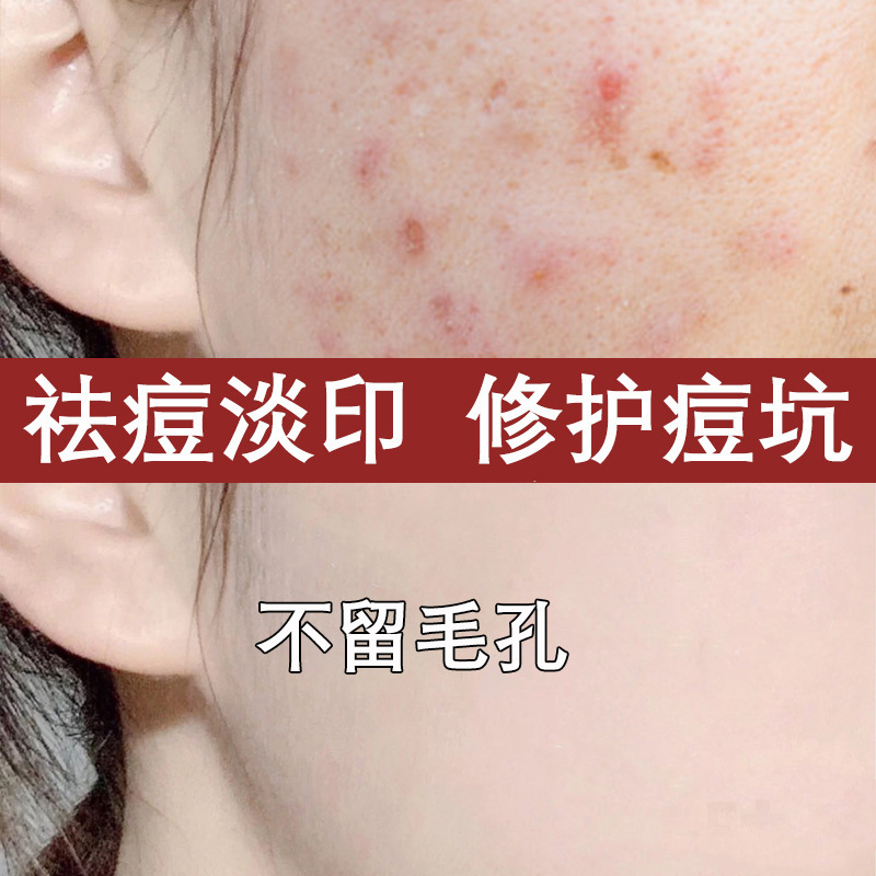サリチル酸の爽やかな肌の水の卸売りは口を閉じてにきびを刺して湿布します。|undefined