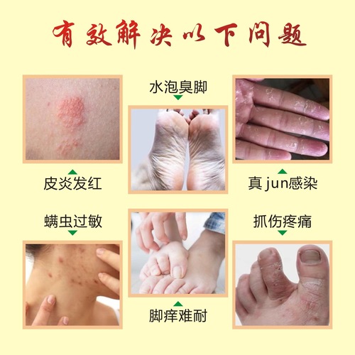 Ancient Village Wonder Herb Soothing Antifungal Cream for Skin Itching, Wet Itching, Joint Pain, and Nerve Relief