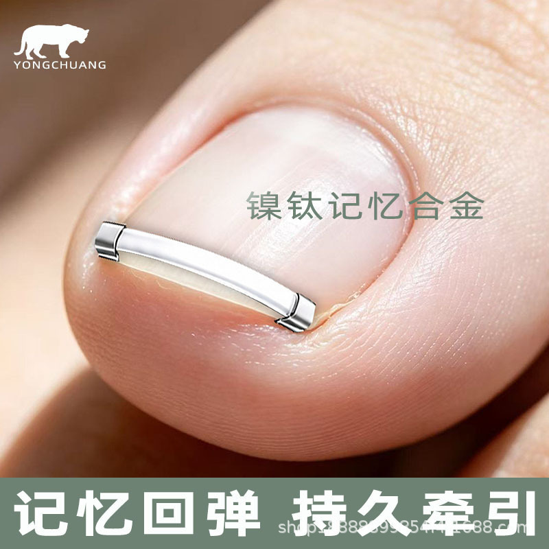 Nail correction sticker, nickel-titanium alloy, ingrown nail puller, anti-imping ingrown nail correction hook, nail correction buckle, nail groove ingrown nail corrector Nail correction sticker, nickel-titanium alloy, ingrown nail puller, anti-imping ingrown nail correction hook, nail correction buckle, nail groove ingrown nail corrector