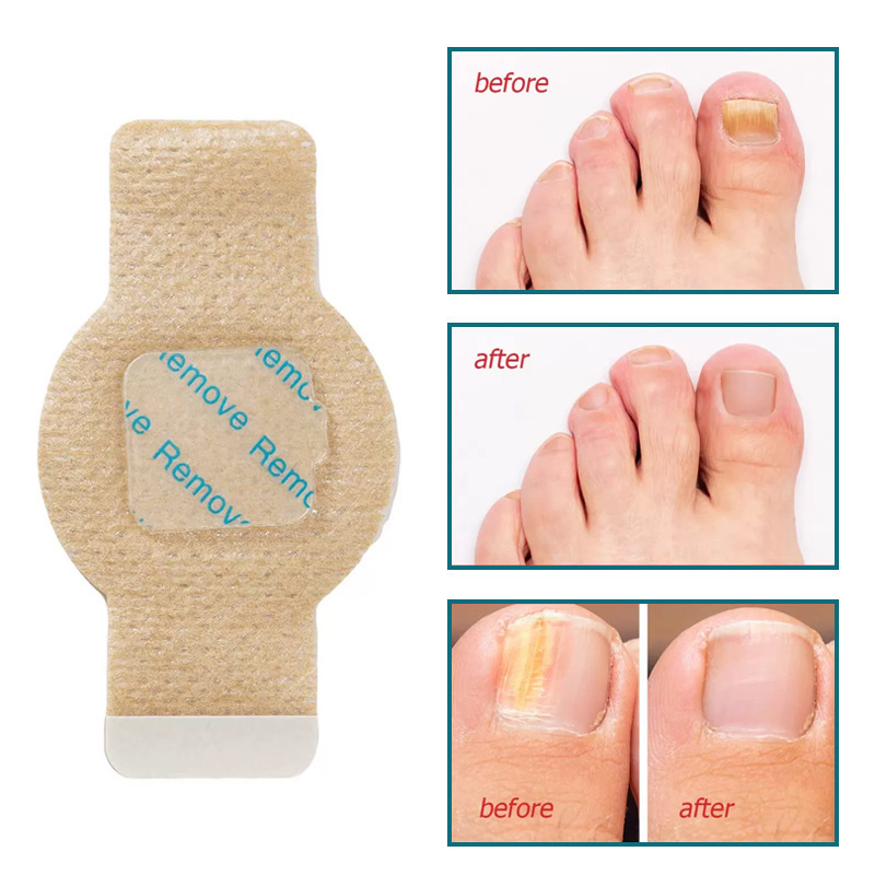 Paste de uñas transfronterizas, fijación, prevención de suciedad, reparación de uñas grises, cuidado de los pies, inflamación de la fossa de las uñas, paste antibacteriano, paste protector de uñas de los dedos de los pies
