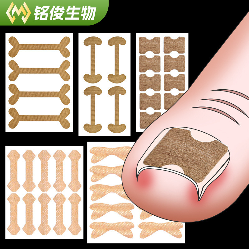 Nail Correction Patch for Ingrown Toenails, Stretch Correction Patch for Nail Groove, Glue-Free Pull-Up Patch for Nail Cuticle Correction Nail Correction Patch for Ingrown Toenails, Stretch Correction Patch for Nail Groove, Glue-Free Pull-Up Patch for Nail Cuticle Correction