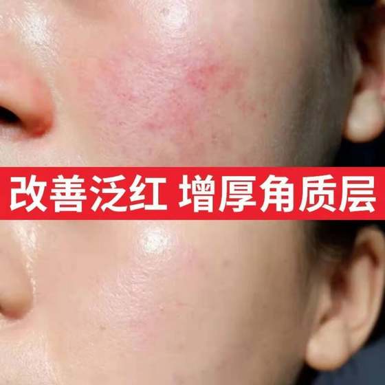 Special Anti-spot liquid repair liquid spot repair and relief period soothing faded red beauty salon repair liquid wholesale