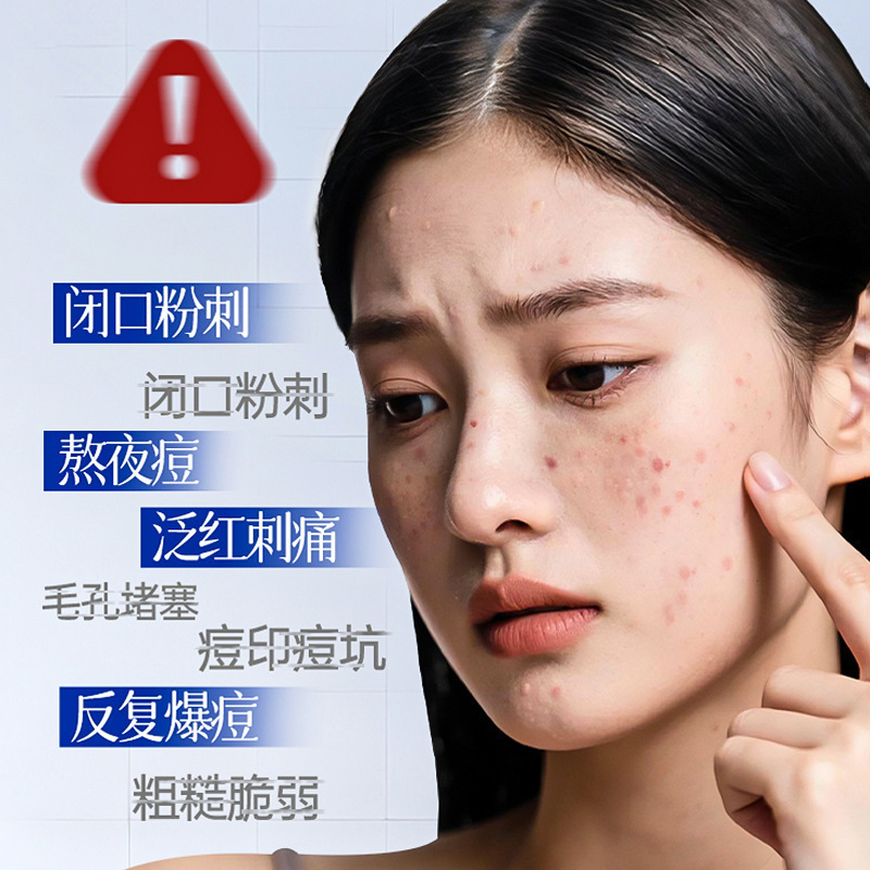 Suxiu Chen 's relajante control de aceite crema de acné para reparar la piel de los adolescentes mejora todo tipo de acné rehidratación no picante fabricante image 3