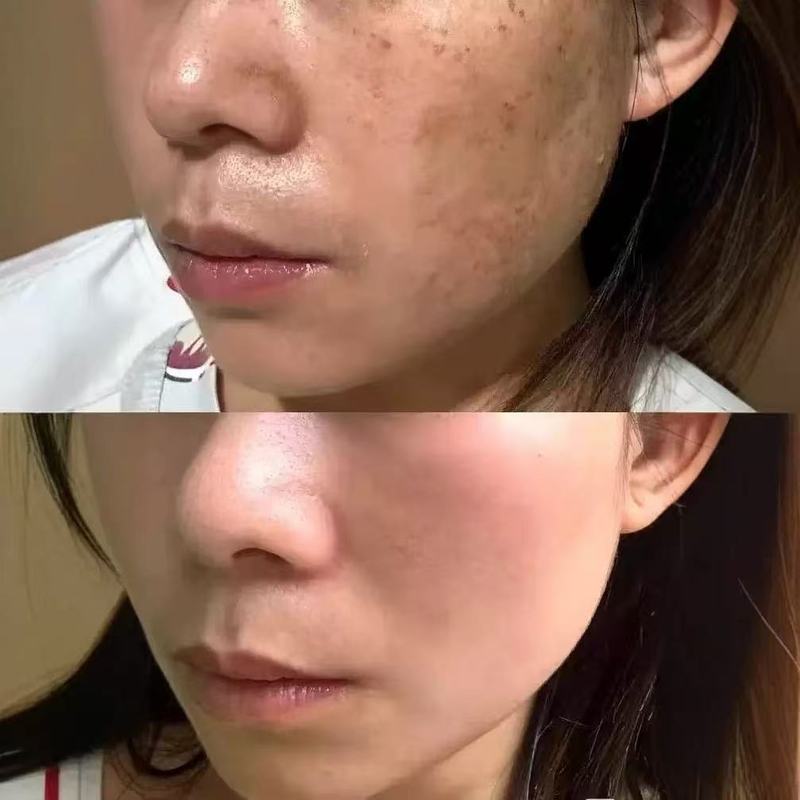 无尴尬期祛斑排色液免提取分解色素去黄褐斑真皮斑代谢液美白控色|undefined