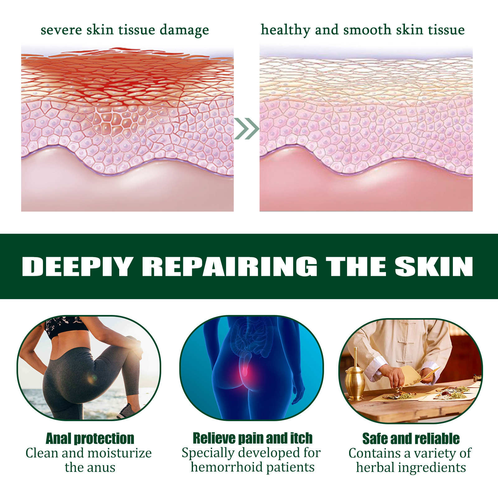 South Moon hemoroīdu noņemšanas kotlešu tūpļa komforta kopšanas ziede, mazina niezi, pietūkumu un sāpes_voghion.com