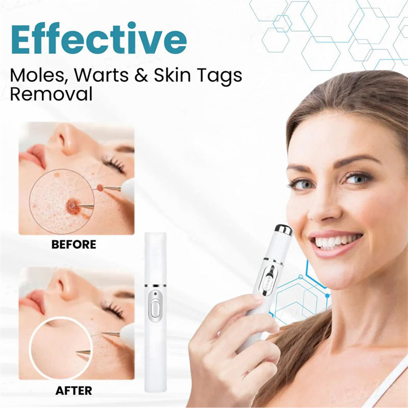 Cross-Border Blue Light Acne Removal Pen, Non-Invasive Laser Mole Removal Pen, Ice Point Beauty Device, Spot Removal Pen, Medical Beauty Mole Removal Pen