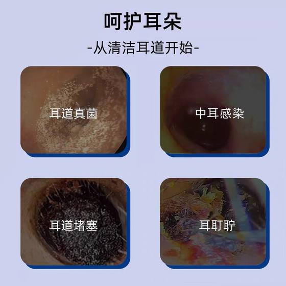 Miao Xianfeng Boric Acid Alcohol Ear Drops External Use Blocking Earplug Bacteriostatic Liquid [One Piece for Hair]]