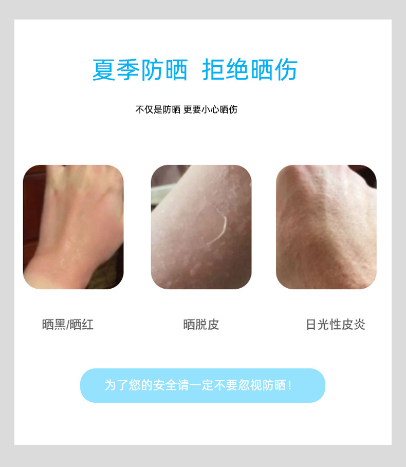晒伤