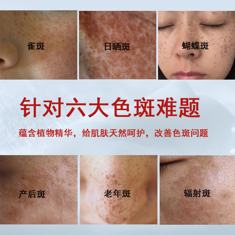 美容院无创溶斑液解分黑色素雀斑黄褐斑退斑液不脱皮倓斑精华液|undefined