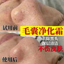 美容院毛囊净化霜清洁膏收缩毛孔霜清洁啫喱去黑头粉刺面部按摩膏