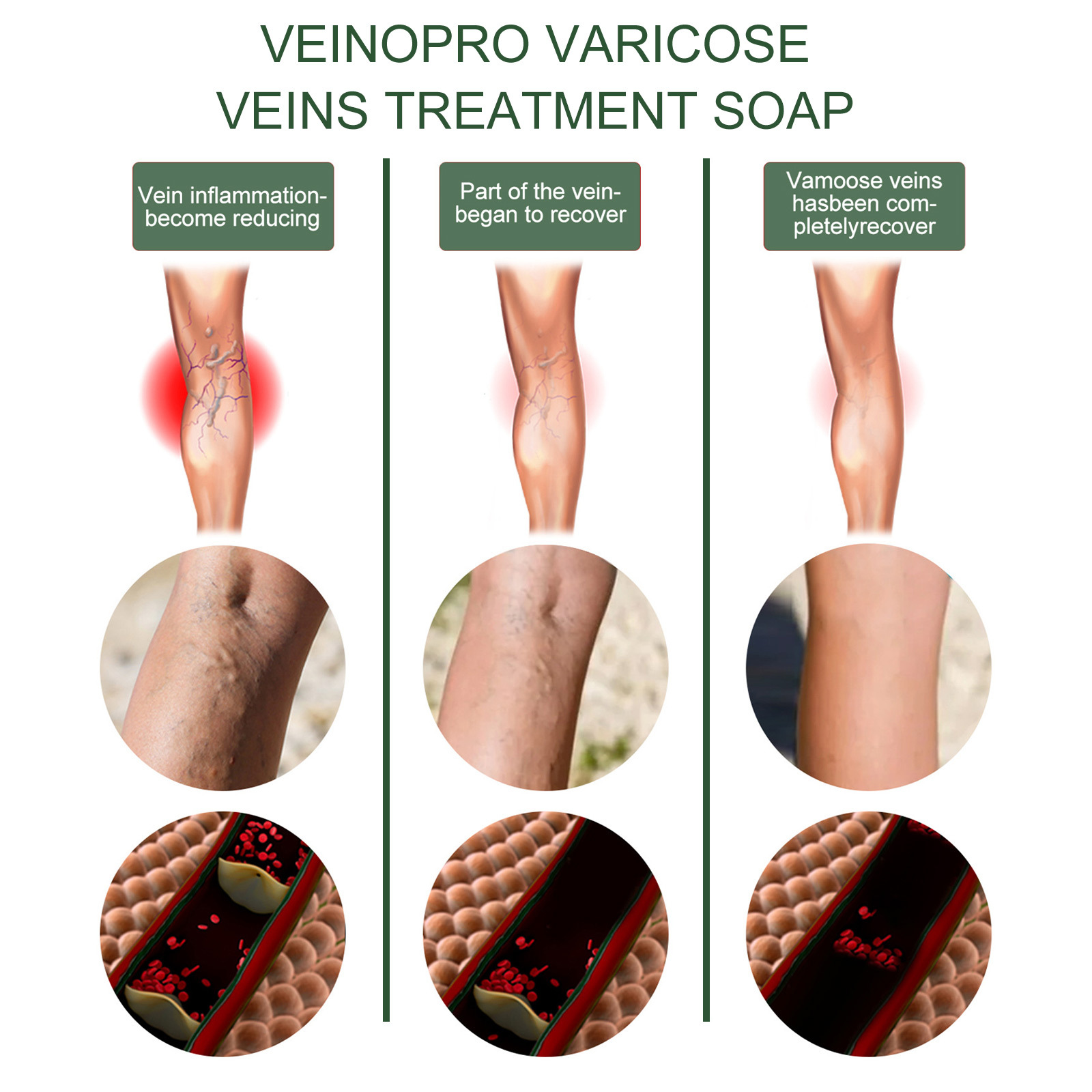 Massaggio endovenoso Eelhoe con sapone per lenire le varici, alleviare le sporgenze nelle gambe dei lombrichi e pulire il polso_voghion.com