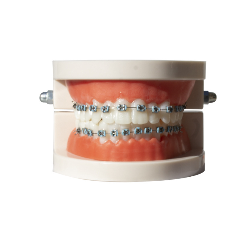 Modelo de corrección dental ortodoncia dental molde de metal de cerámica soporte de contraste arco modelo de visualización de alambre