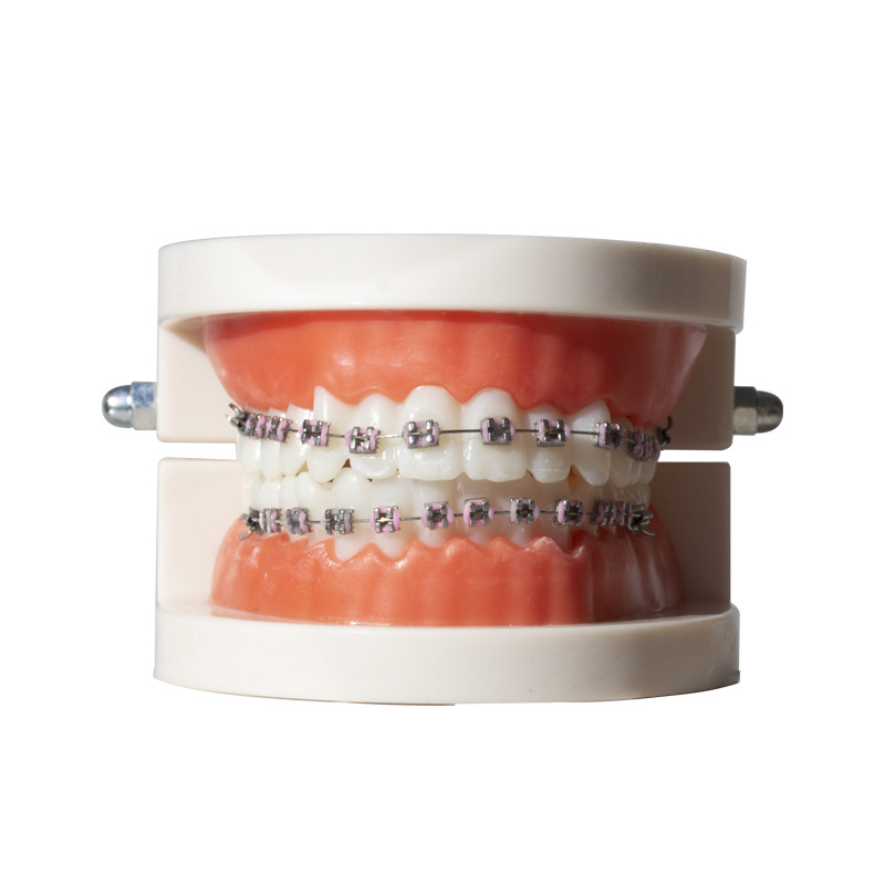 Modelo de corrección dental ortodoncia dental molde de metal de cerámica soporte de contraste arco modelo de visualización de alambre