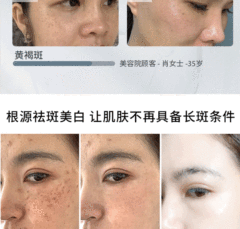 377 Whitening and Spot Removal Cream for Hyperpigmentation, Sun Spots, Spot Removal, Whitening, Brightening, Post-Treatment Color Control, and Targeted Spot Removal Night Cream