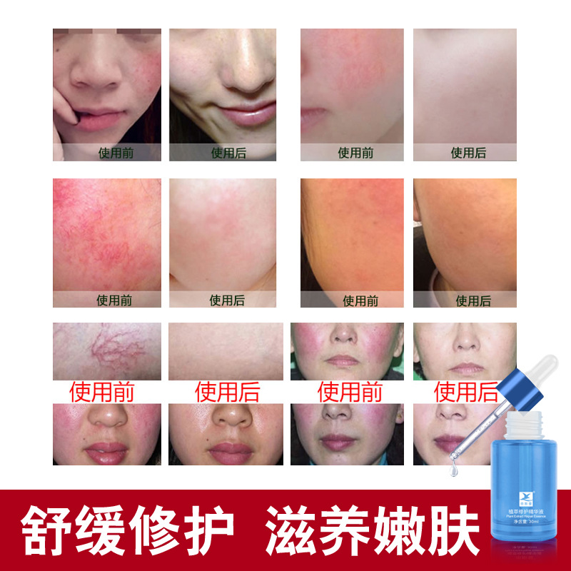 植萃修户原液红血丝脸部泛红敏感肌修户角质层增厚非去除精华液
