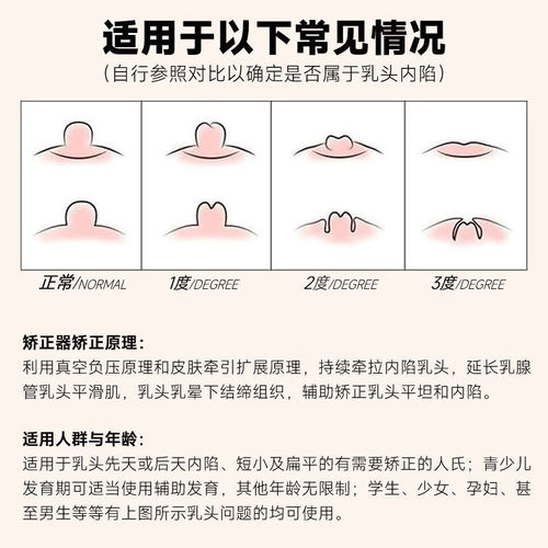 Nipple corrector physically corrects suction and extraction depression, feeding flattening, correction of nipple traction for girls, traction device for indentation