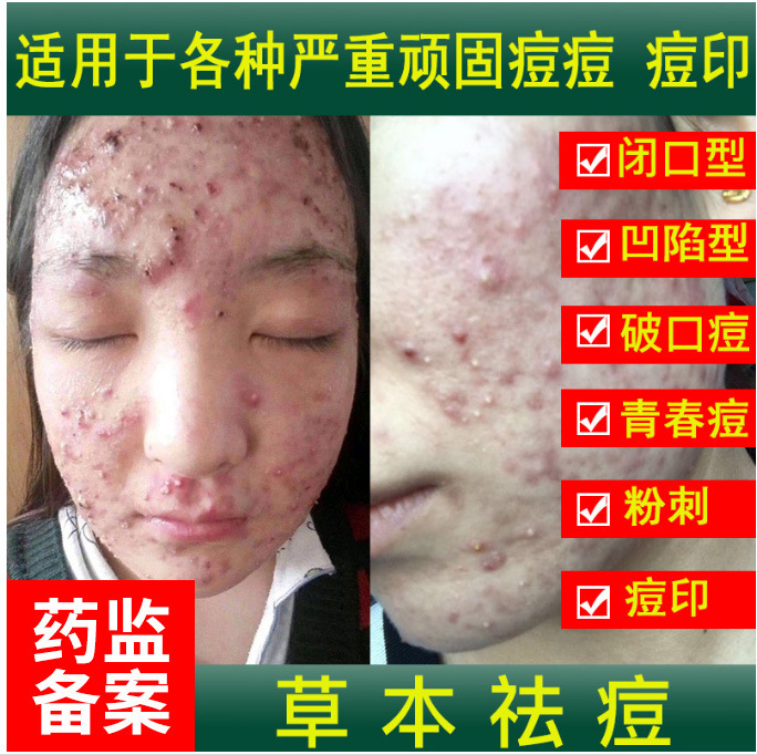 Herbal anti-acne products anti-acne marks acne scars acne before acne men fade female students factory direct supply