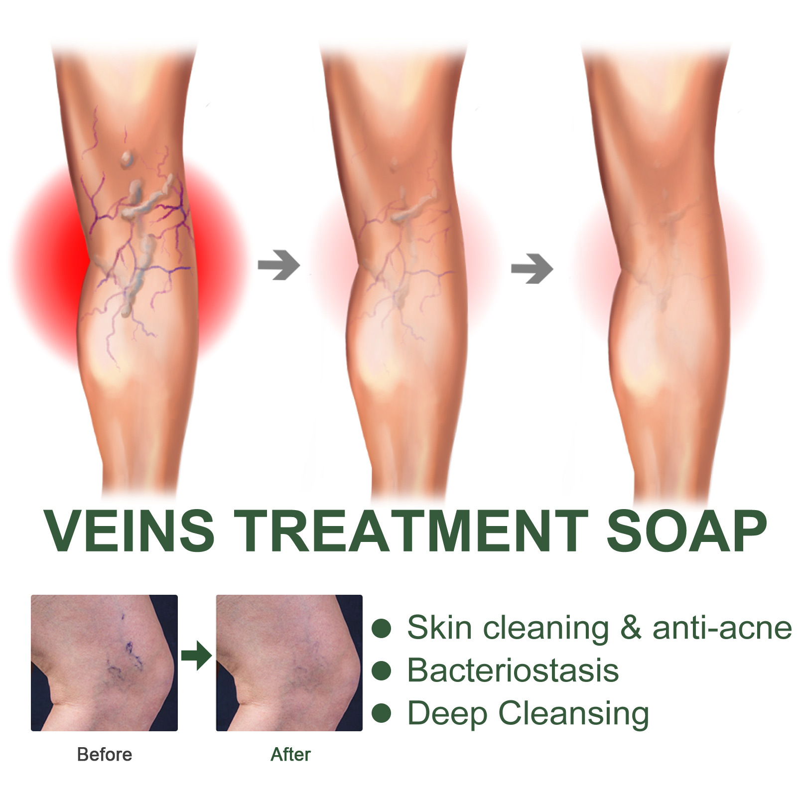 Massaggio endovenoso Eelhoe con sapone per lenire le varici, alleviare le sporgenze nelle gambe dei lombrichi e pulire il polso_voghion.com