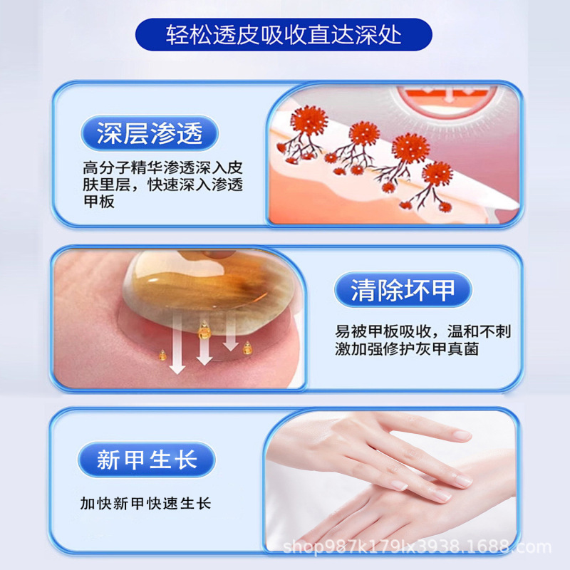 香港薬局爪真菌症オランダマリーア外用健康液爪除去クリーム爪真菌症黒爪厚い爪外用健康液|undefined
