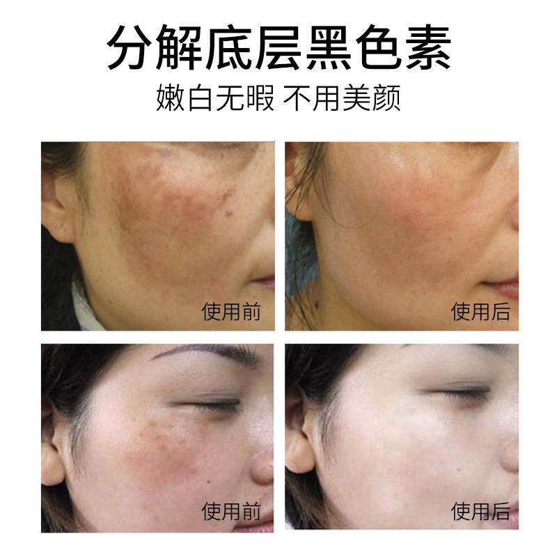 美容室の非侵襲性スポット溶解液、非ピーリング、スポット除去液、メラニン分解、スポット除去、スポット美白エッセンス|undefined