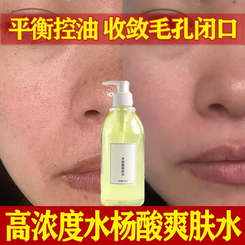 水杨酸爽肤水高浓度去闭口粉刺湿敷水淡化痘印毛孔粗大果酸精华液