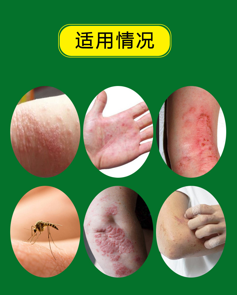 Thai Itch Relief Ointment External Skin Balm 20g Traditional Herbal Topical for Neck Area in use
