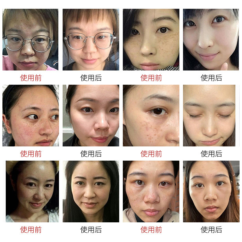 肝斑色素分解クリーム、肝斑・そばかす除去、色素分解、美白、恥ずかしくない美白・そばかす除去セット|undefined