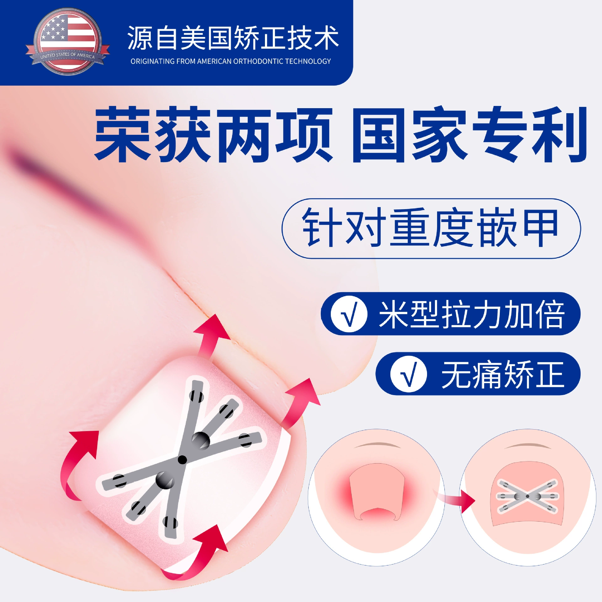 Гвоздь инкрустированный никель-титановый сплав бионическая кость пластырь пластырь