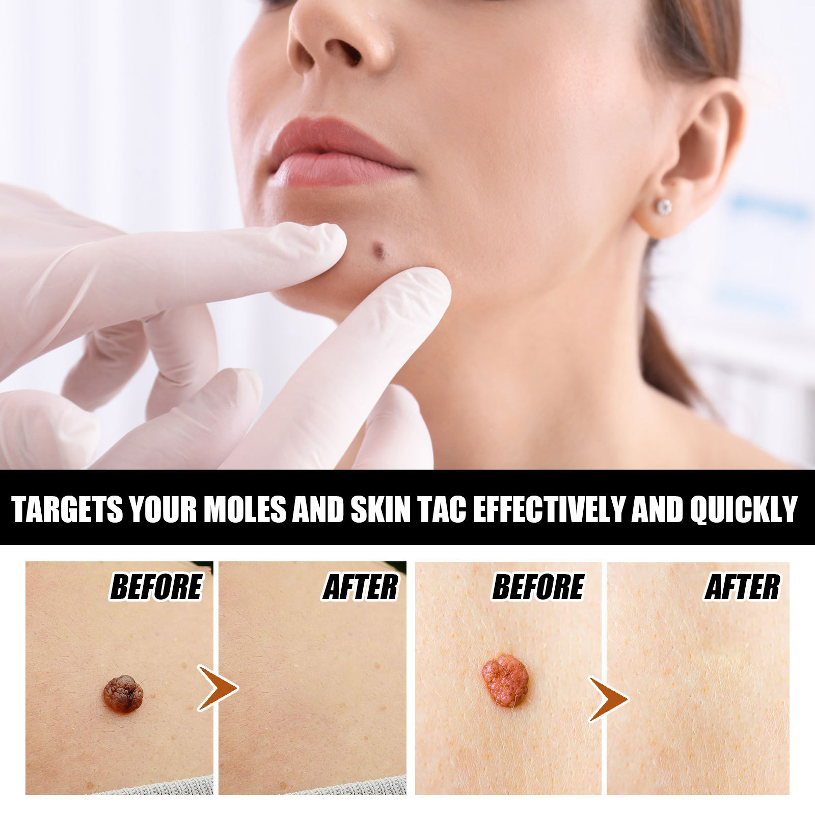 EELHOE repairing spots essence for skin flattening, wart removing and nevus eliminating solution_voghion.com