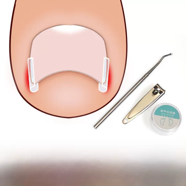 Nail Pad Nail Groove Inlay Nail Corrector Nail Pad Roll Nail Corrector Pull and Stick Toenail Long into Meat