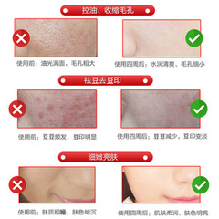 水楊酸爽膚水批發去閉口粉刺濕敷水祛痘修復毛孔粗大果酸精華液