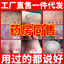 湿诊疹止痒去腿根皮肤阴囊瘙痒牛皮股顽癣固皮炎汗疱泡疹药膏