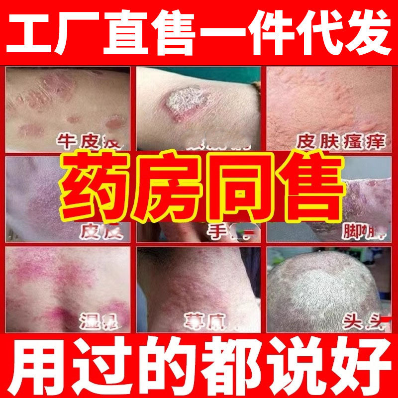 湿診かぶれはかゆみを止めて足の根の皮膚の陰嚢に行ってかゆい牛革の株の頑固な水虫の固皮炎の汗の水疱瘡の薬の膏を取り除きます。|undefined