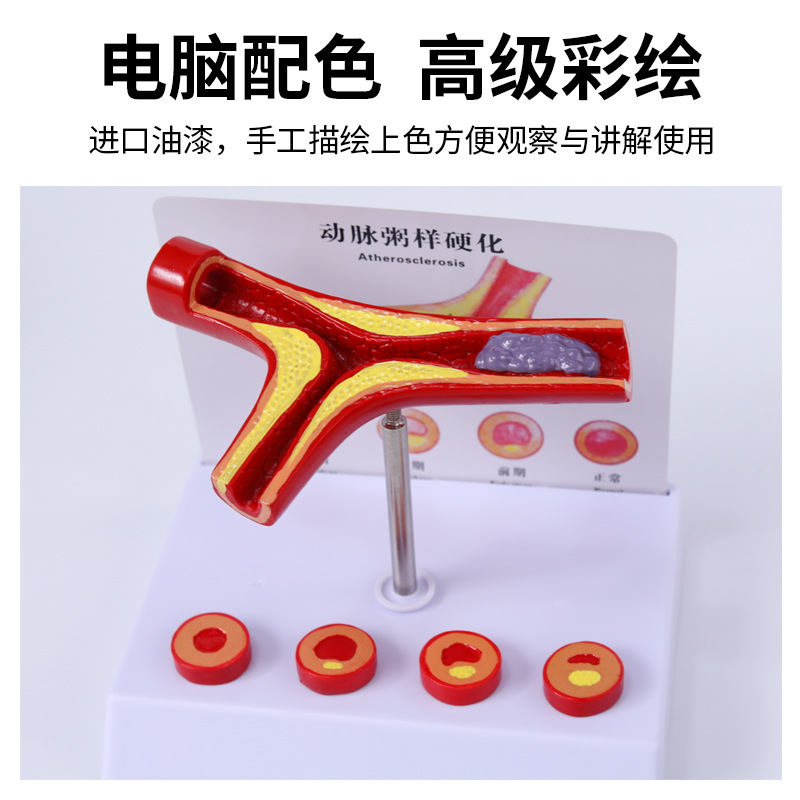 Modelo de la arteria coronaria Modelo de la arteria cardiovascular modelo de endurecimiento