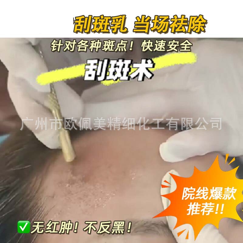 美容業界で人気の斑点除去技術は、真皮のそばかすやシミを深く除去し、恥ずかしくなく黒ずみを防ぎます。|undefined