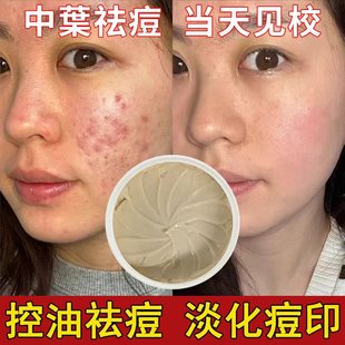Hospital Herbal Anti-Acne Cream to Fade Acne Marks, Acne Pits, Acne Closed Mouth, Mild Repair, Powerful Anti-Acne Cream