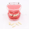 Dental teaching model doctor-patient communication model comprehensive case model removable dental model implant restoration model