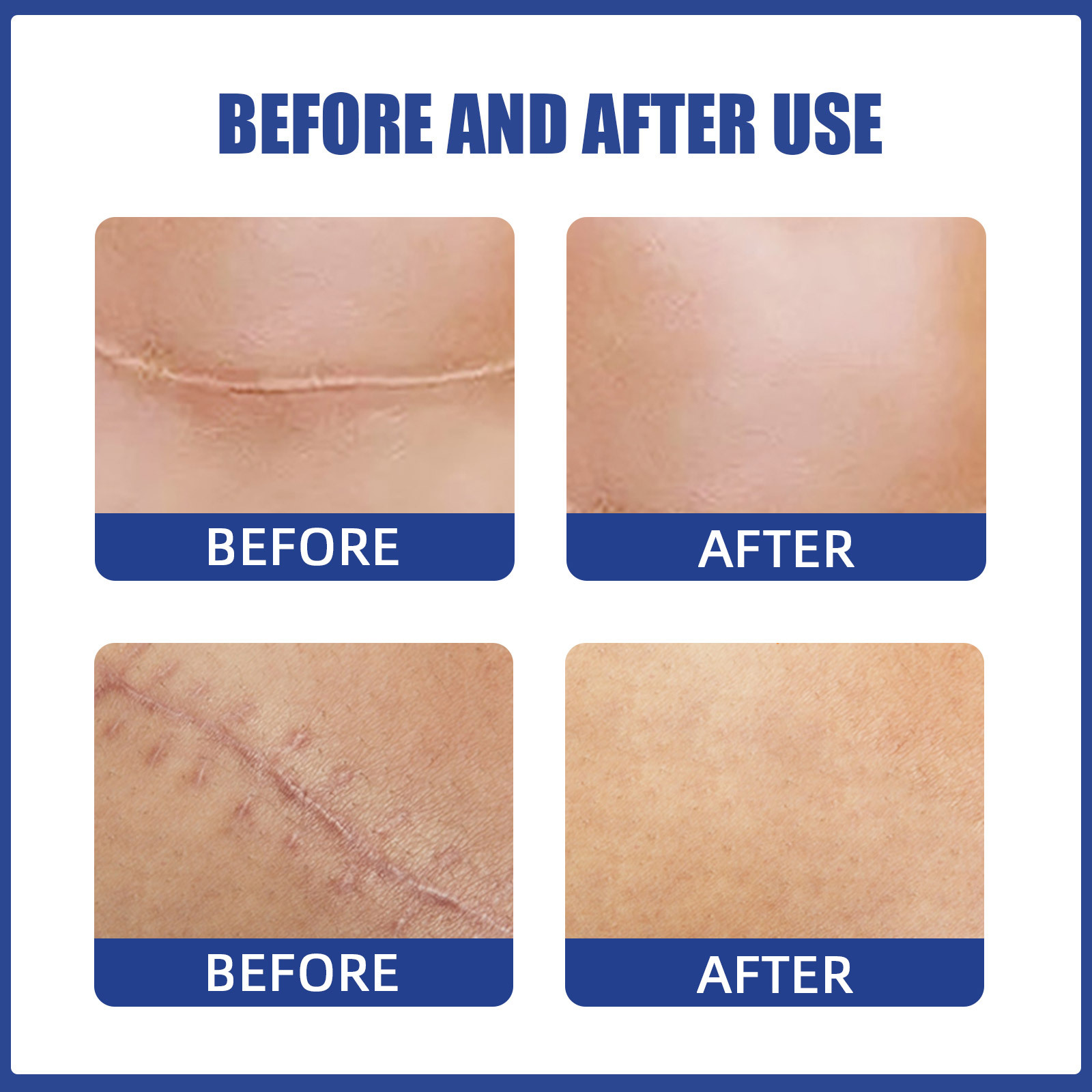 EELHOE Patch per cicatrici al seno Ripara le cicatrici della pelle, è comodo, leggero e leviga le cicatrici chirurgiche al seno, (confezione da 2)_voghion.com