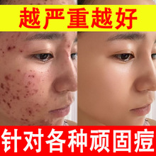草本祛痘精华液淡化痘印痘坑细致毛孔青春痘修复液美容院祛痘原液