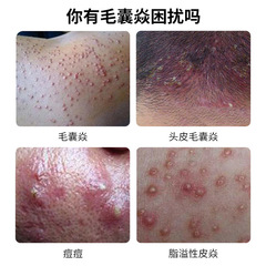 Kawai Hongyan Hair Follicle Health Cream 30g Hair Follicle Blockage, Acne, Seborrhoea, Hair Follicle Pimple, Uncomfortable Body Care Cream