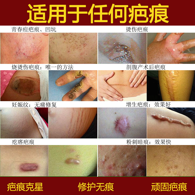 美容院疤痕膏修复无痕去剖腹产疤痕手术增生产后烧烫修护疤痕凝胶