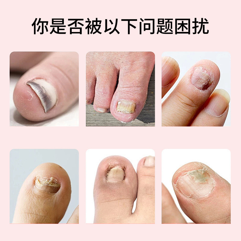 爪真菌症ソリューションフットケアソリューション爪真菌症健康ソリューション肥厚明るい爪真菌症ネットソフト爪クリーム爪真菌症ソリューション卸売|undefined