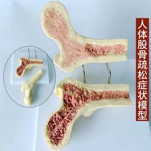 Human femoral osteoporosis anatomical model leg bone anatomical surface spinal section specimen lesion lumbar spine model