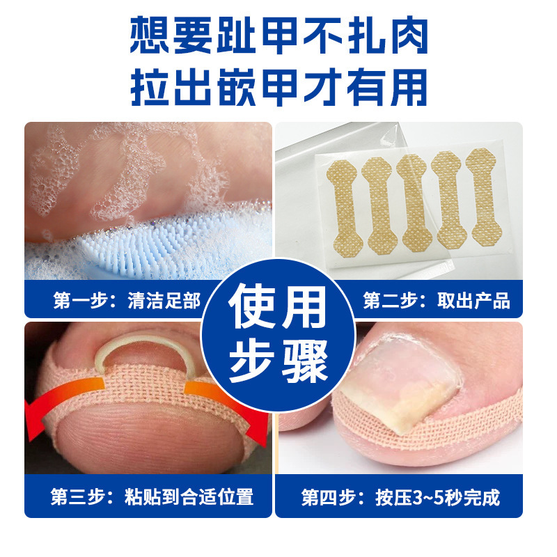 跨境指甲矫正贴甲沟正甲贴脚趾嵌甲贴改善甲沟内卷指甲贴套装工厂|undefined