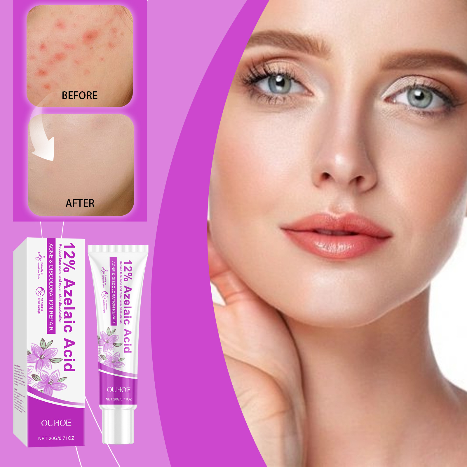 OUHOE Azelaic Acid Acne Care Cream Fades Acne to Improve Redness and Gentle Moisturizing Skin Care Cream
